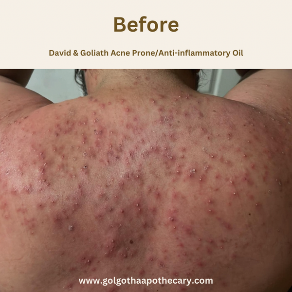 David & Goliath Anti-Inflammatory/Acne Prone Face Oil